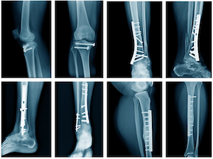 Leg Injury Xray