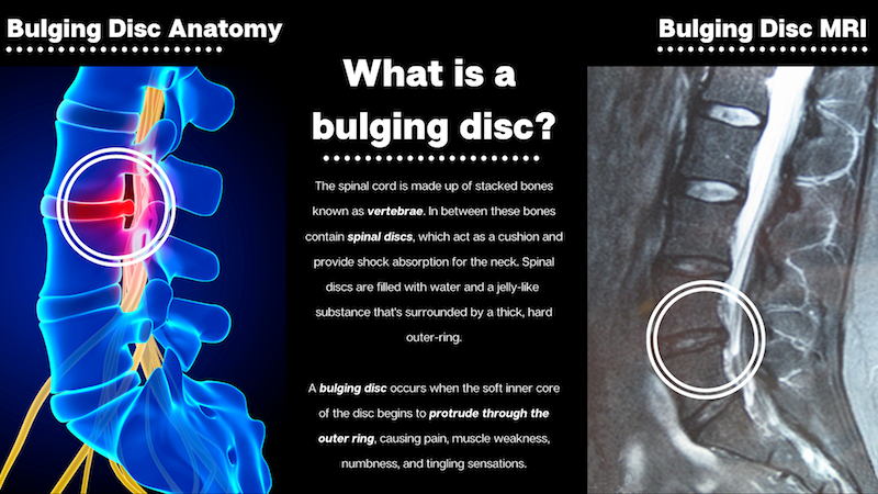 Bulging Disc Infographic