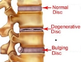 Normal Disc