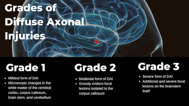 Grades of Difuse Axonal Injuries