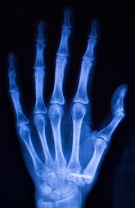 Hand Xray