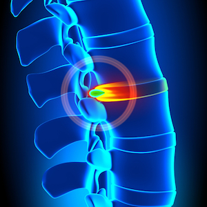 Herniated Disc Pain