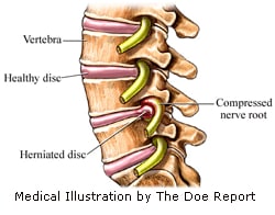 Herniated Disc