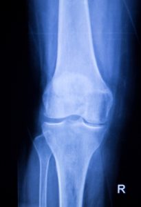 Broken Leg (Femur, Tibia, Fibula) Compensation Payouts (2023)