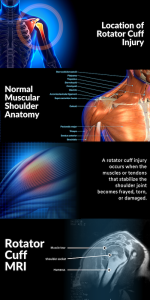 Rotator Cuff Injuries