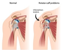 Rotator Cuff Injuries