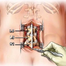 Spinal Surgery