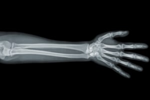 Xray Arm