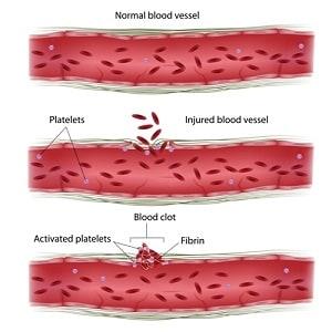 blood clot dentist