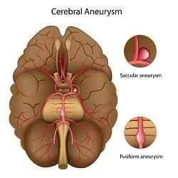 brain aneurysm lawyer