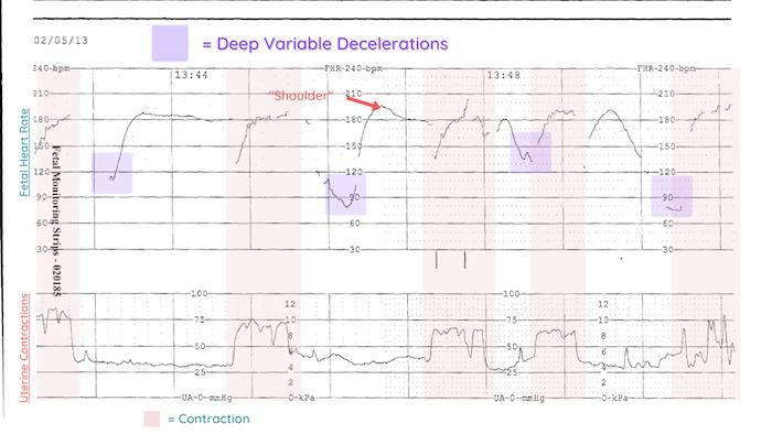 Deep Variable Decelerations