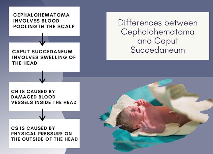 Cephalohematoma Versus Caput Succedaneum