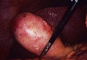 gallbladder surgery