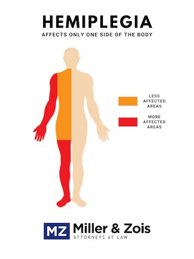 hemiplegic cerebral palsy