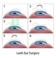 eyesurgerymistakes