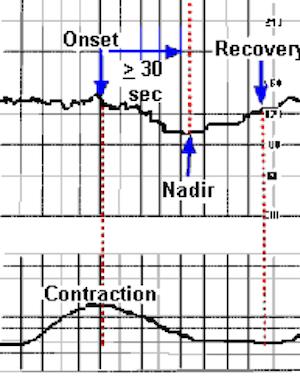 late deceleration