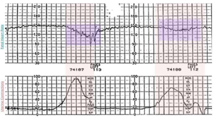 late decelerations childbirth