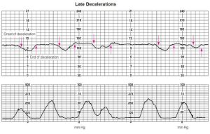 late_decelerations_dld-300x191