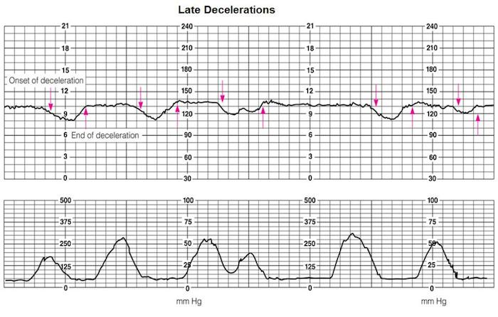 Recurrent Late Decelerations Birth Injury Lawyers recurrent-late-decelerations-birth-injury-lawyers