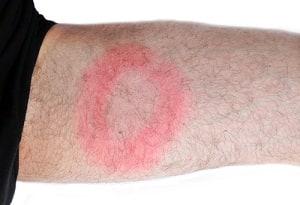 lyme disease malpractice