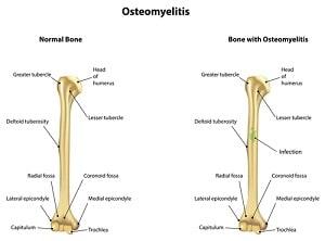 osteomyelitis