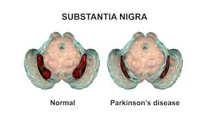 Parkinson’s Disease