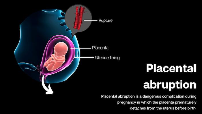 Placental Abruption Infographic