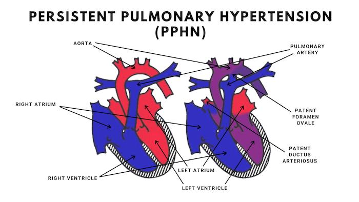 Persistent Pulmonary Hypertension Lawsuit