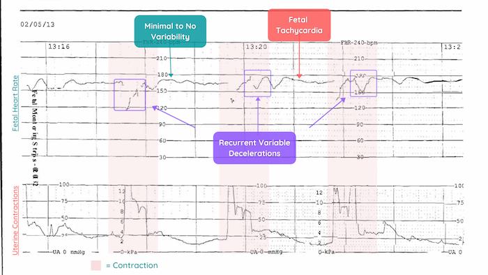 Recurrent Variable Decelerations