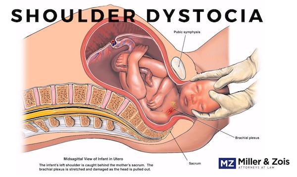 shoulder dystocia lawsuits