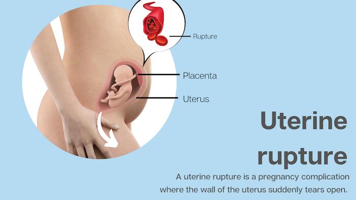 Uterine Rupture Infographic