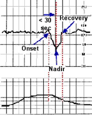 variable deceleration