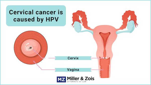 cervical cancer misdiagnosis