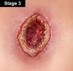bed sores