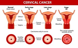 cervical cancer lawsuit