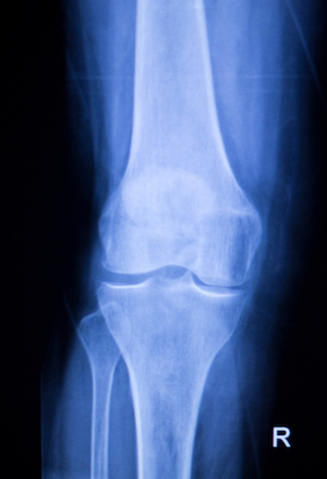Broken Leg Injury Claims Xray