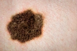 melanoma viagra