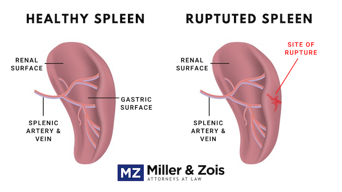spleen injury trauma