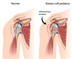 injury shoulder value