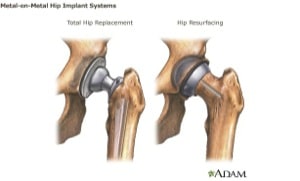 Metal Hip Replacement