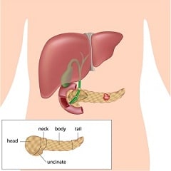 Pancreatic Cancer