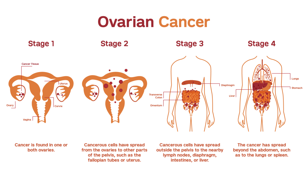 Hair Relaxer Ovarian Cancer Lawsuit