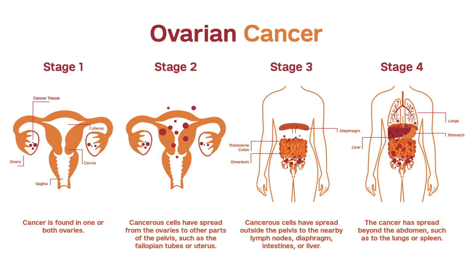 Hair Relaxer Ovarian Cancer Lawsuit January 2023