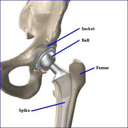 Hip Implants