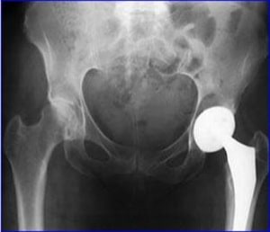 Stryker Hip Implants