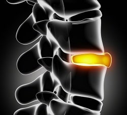 disc injury montgomery county